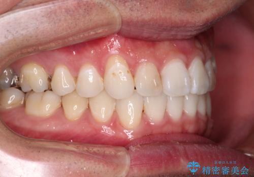 【モニター】 インビザライン・ライトによる軽微叢生の矯正治療の治療後