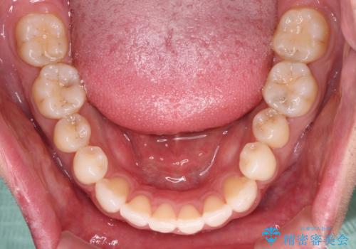 【モニター】 インビザライン・ライトによる軽微叢生の矯正治療の治療後