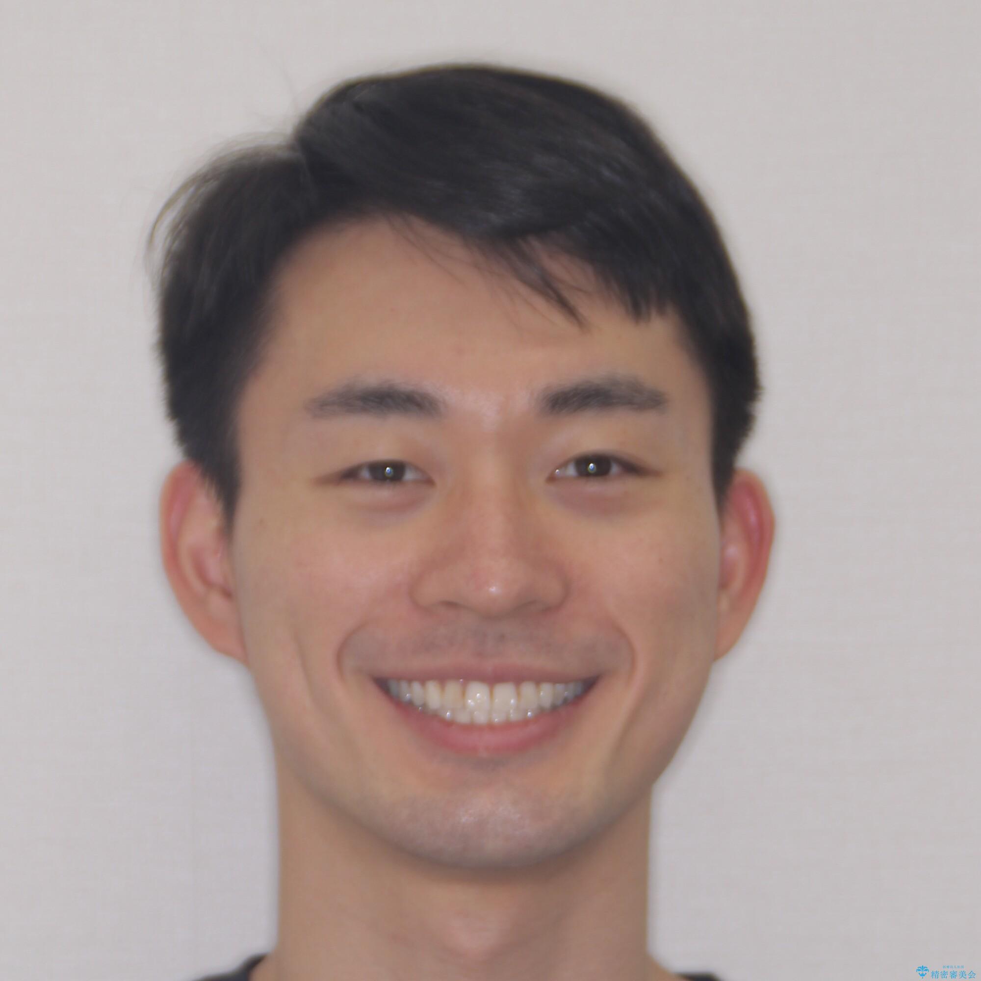 【モニター】 インビザライン・ライトによる軽微叢生の矯正治療の治療後(顔貌)