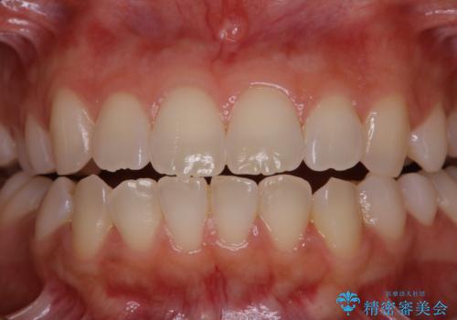 親知らずの抜歯前にPMTCの治療前