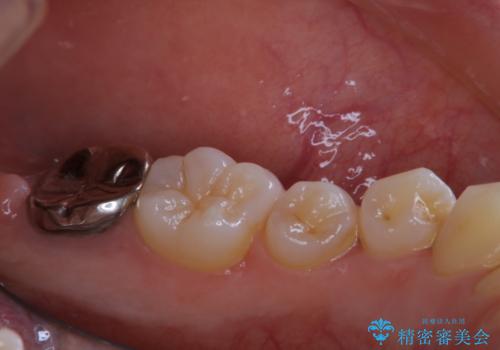 親知らずの抜歯前にPMTCの治療前