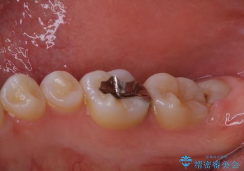 親知らずの抜歯前にPMTCの治療前