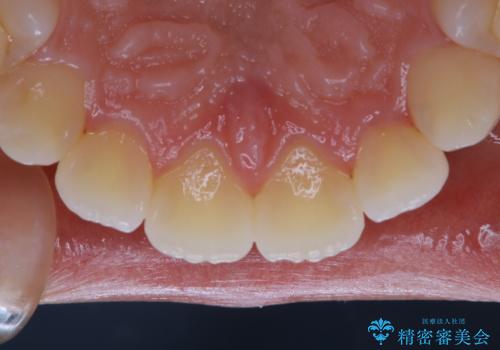 親知らずの抜歯前にPMTCの治療前