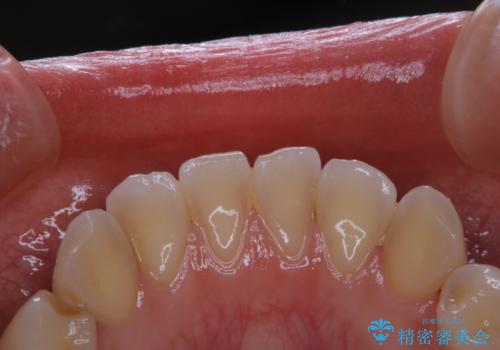 親知らずの抜歯前にPMTCの治療前