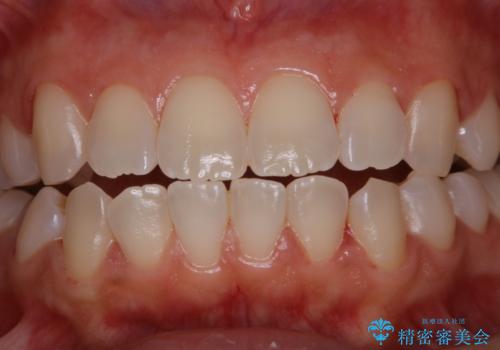 親知らずの抜歯前にPMTCの治療後