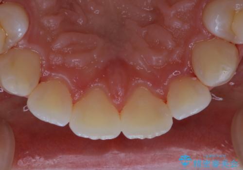 親知らずの抜歯前にPMTCの治療後