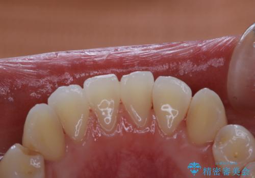 親知らずの抜歯前にPMTCの治療後