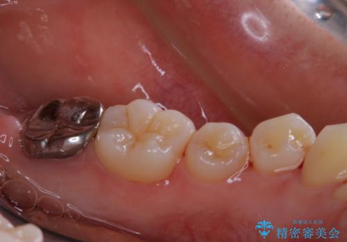 親知らずの抜歯前にPMTCの治療後