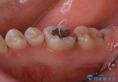 親知らずの抜歯前にPMTC