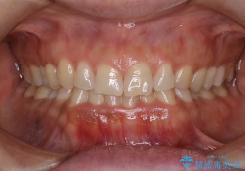 歯を自然な白さにしたい(スペシャルホワイトニング)の症例 治療前