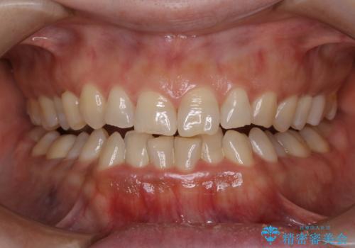 歯を自然な白さにしたい(スペシャルホワイトニング)の治療前