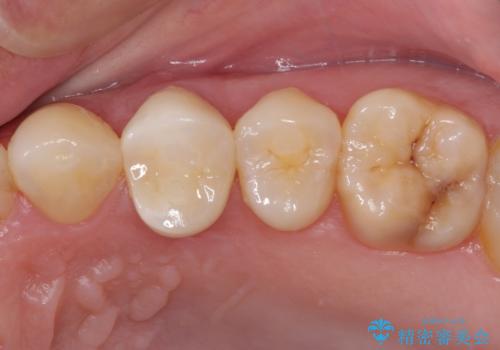 食事をするときに痛む　根管治療とセラミック補綴治療の症例 治療後