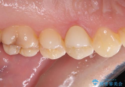 食事をするときに痛む 根管治療とセラミック補綴治療の治療後
