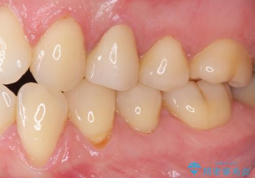 食事をするときに痛む 根管治療とセラミック補綴治療の治療後