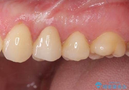 食事をするときに痛む 根管治療とセラミック補綴治療の治療後