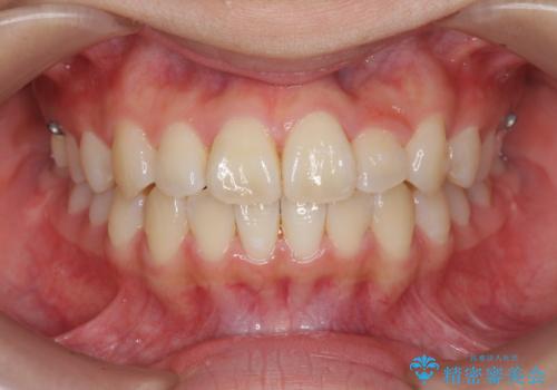 [インビザライン]  前歯のガタつき・すれ違い　マウスピース矯正治療の症例 治療後
