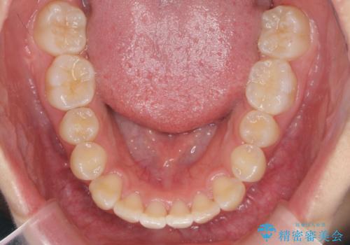 [インビザライン]  前歯のガタつき・すれ違い　マウスピース矯正治療の治療後
