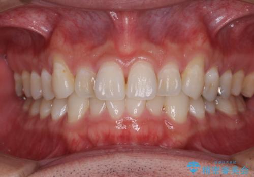 【モニター】 インビザライン・ライトによる軽微叢生の矯正治療の症例 治療前