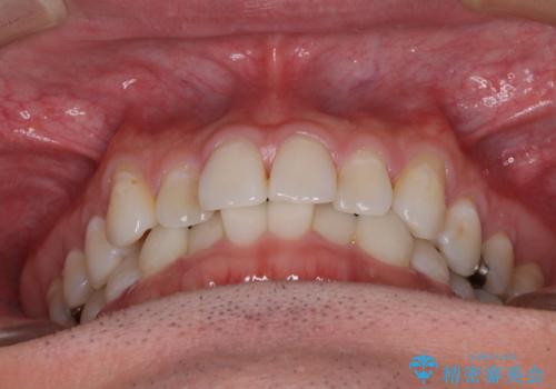 【モニター】 インビザライン・ライトによる軽微叢生の矯正治療の治療前