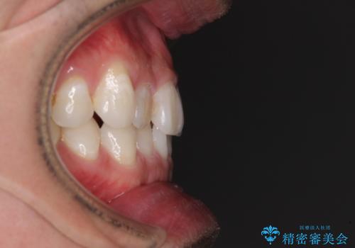 【モニター】 インビザライン・ライトによる軽微叢生の矯正治療の治療前