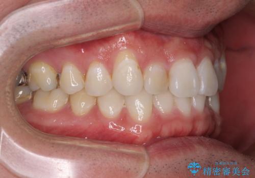 【モニター】 インビザライン・ライトによる軽微叢生の矯正治療の治療前
