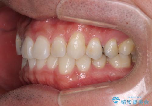 【モニター】 インビザライン・ライトによる軽微叢生の矯正治療の治療前