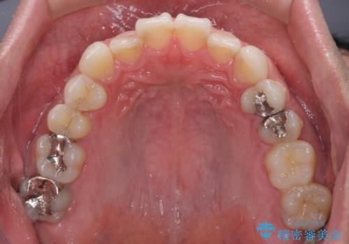 【モニター】 インビザライン・ライトによる軽微叢生の矯正治療の治療前