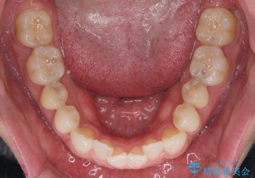 【モニター】 インビザライン・ライトによる軽微叢生の矯正治療の治療前
