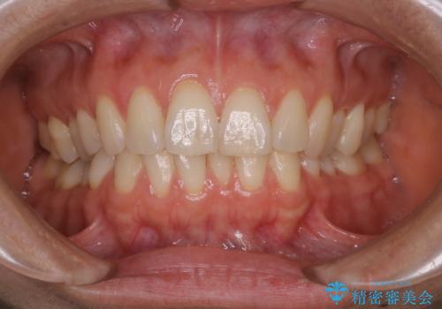 上下の真ん中を合わせて横顔シルエットも改善の症例 治療前