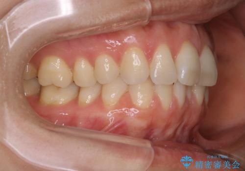 上下の真ん中を合わせて横顔シルエットも改善の治療前