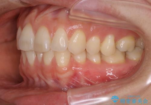 上下の真ん中を合わせて横顔シルエットも改善の治療前