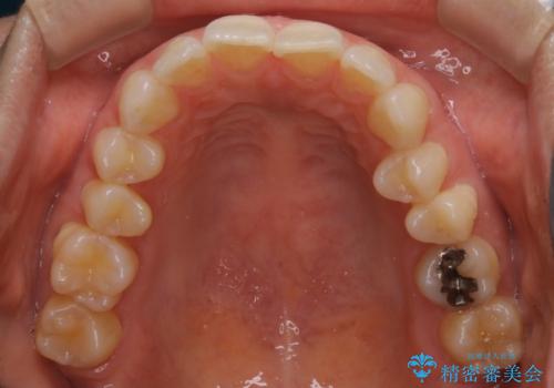 上下の真ん中を合わせて横顔シルエットも改善の治療前