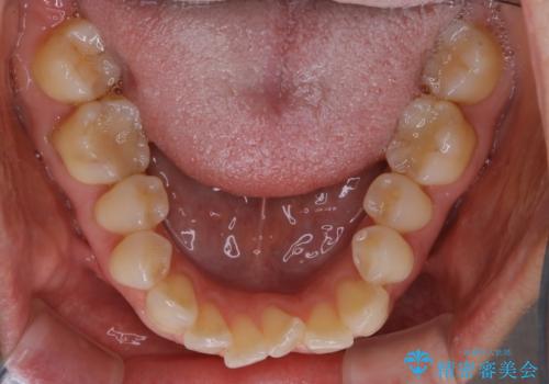 上下の真ん中を合わせて横顔シルエットも改善の治療前