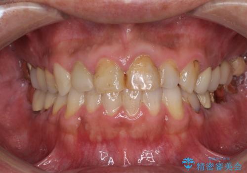抜歯が必要な左右の奥歯　ブリッジとインプラントによる奥歯の補綴治療の症例 治療前