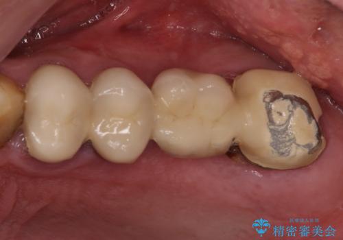 抜歯が必要な左右の奥歯 ブリッジとインプラントによる奥歯の補綴治療の治療前
