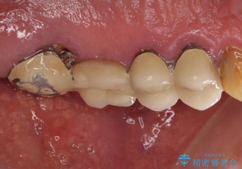 抜歯が必要な左右の奥歯 ブリッジとインプラントによる奥歯の補綴治療の治療前