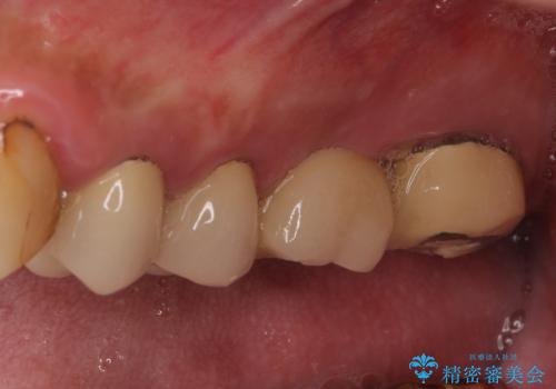 抜歯が必要な左右の奥歯 ブリッジとインプラントによる奥歯の補綴治療の治療前