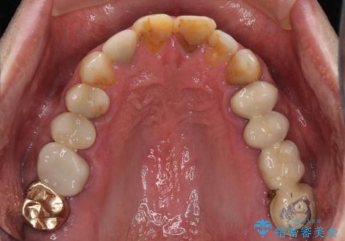 抜歯が必要な左右の奥歯 ブリッジとインプラントによる奥歯の補綴治療の治療前