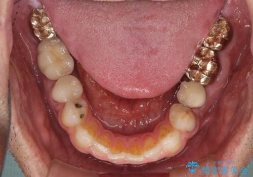 抜歯が必要な左右の奥歯 ブリッジとインプラントによる奥歯の補綴治療の治療前