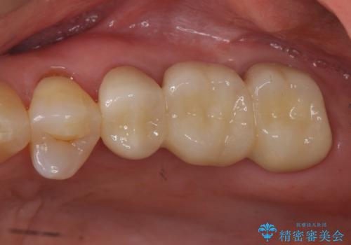 前歯が反対になっている マウスピース矯正+奥歯ブリッジの治療後
