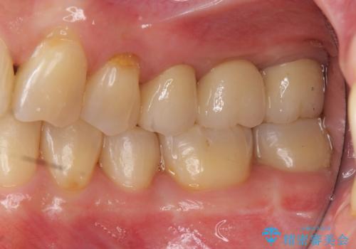 前歯が反対になっている マウスピース矯正+奥歯ブリッジの治療後