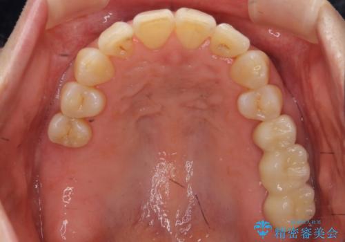 前歯が反対になっている マウスピース矯正+奥歯ブリッジの治療後