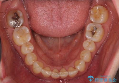 前歯が反対になっている マウスピース矯正+奥歯ブリッジの治療後