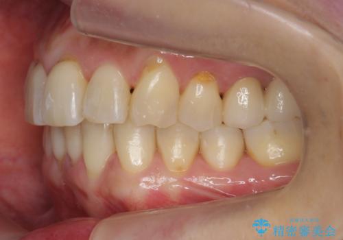 前歯が反対になっている マウスピース矯正+奥歯ブリッジの治療後