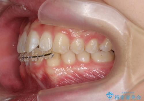 [ Three-incisor ]  歯肉退縮した歯を抜去しマウスピース治療で改善の治療中