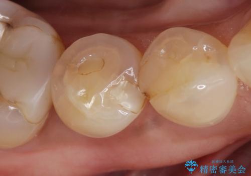 歯が欠けて舌が引っかかる　セラミックインレー　50代女性の症例 治療前