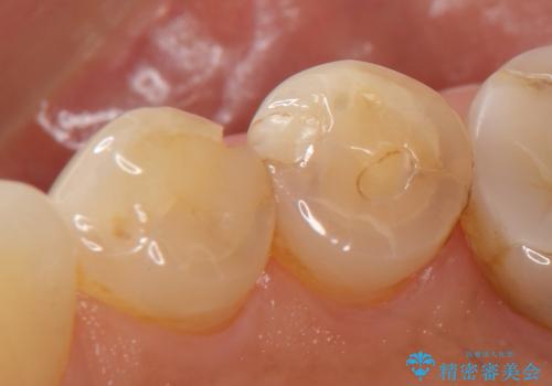 歯が欠けて舌が引っかかる セラミックインレー 50代女性の治療前