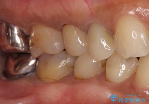 歯が欠けて舌が引っかかる セラミックインレー 50代女性の治療前