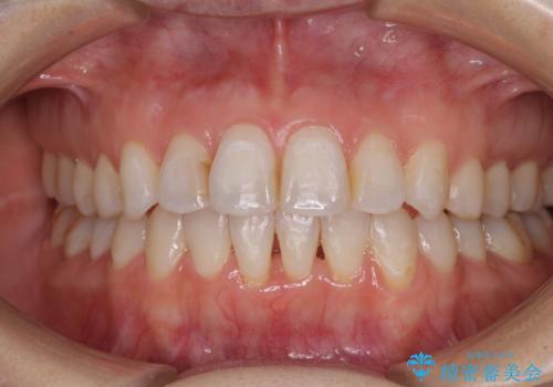 長年気にしていた前歯 インビザラインで目立たず改善の治療中
