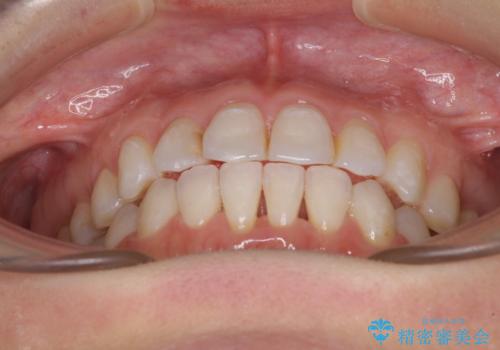 長年気にしていた前歯 インビザラインで目立たず改善の治療中